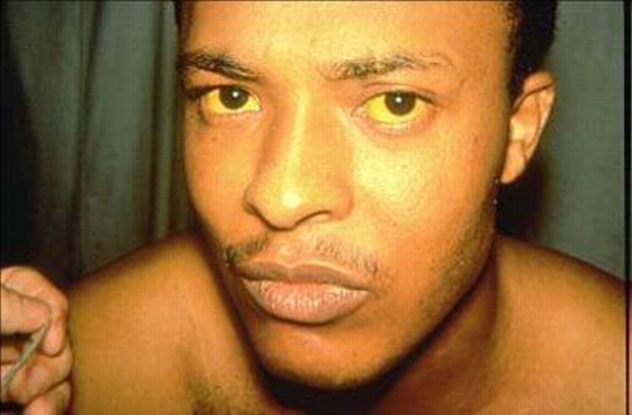 People Infected With Yellow Fever | www.galleryhip.com - The Hippest Pics
